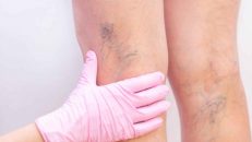 Los mejores métodos para eliminar varices sin cirugía
